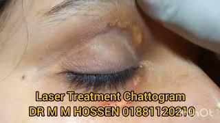 Xanthelasma treatment now in Chittagong Chattogram  01881120210