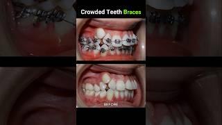 40 months for this braces. Crowded teeth #braces #orthodontist #dentist #dentistry