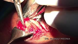 Jones procedure for involutional entropion