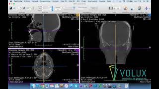 Volux - Tutorial OsiriX Lite parte 2 di 2