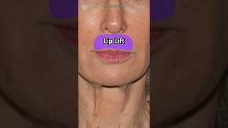 Beautiful Lip Lift Results #cosmeticsurgery #lips #lip