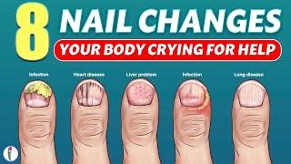 Nail signs of Disease | Nail pitting | Finger clubbing | Signs of anemia | Terry's nails