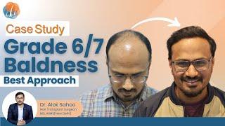 How to handle Grade 6/7 baldness? | Best approach by Dr Alok Sahoo | Hair transplant Surgeon