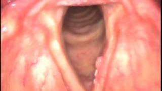 Carcinoma in Situ Larynx