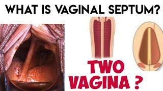 Double vagina? What is vaginal septum?