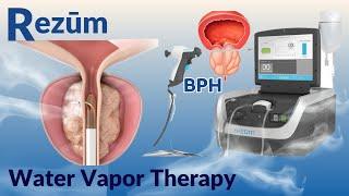 A mininal invazive Benign Prostate Surgery: REZUM Water Vapor Therapy