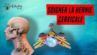 SOIGNER LA HERNIE DISCALE CERVICALE [Explications et exercices]