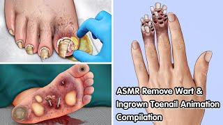 ASMR Remove Wart & Ingrown Toenail Animation Compilation - Deep Cleaning Animation