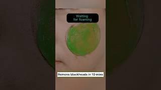 Remove blackheads naturally at home #shorts #youtubeshorts #skincare #beautytips #homeremedies