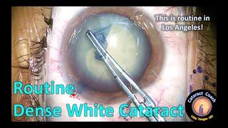 routine dense white cataract surgery in Los Angeles