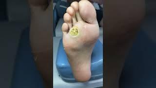 Eng Sac calluses corn foot spa 修脚师傅林俊 #PLC03