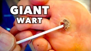 SCRAPING OFF A GIANT DEAD WART! | Dr  Paul