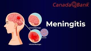 Meningitis