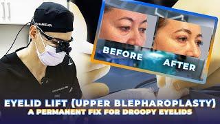 Eyelid Lift (Upper Blepharoplasty) - A Permanent Fix For Droopy Eyelids