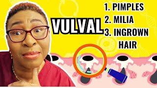 How To Treat 3 Common Vulval Lumps