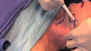 Neck Lift - Surgical Procedure By Dr. Craig Jonov, Seattle WA
