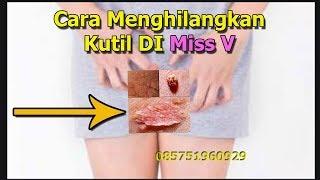 Cara Menghilangkan Kutil DI Miss V