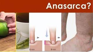 ANASARCA Clinical Treatment Approach / MEDICINE