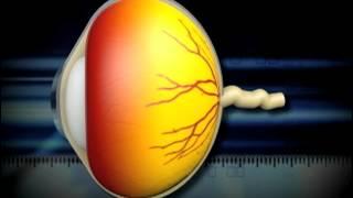 Glaucoma, A Stealth Disease And Major Cause of Blindness