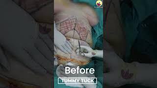 Tummy Tuck Before and After Results | Dr. Ritesh Anand #shorts #shortsfeed