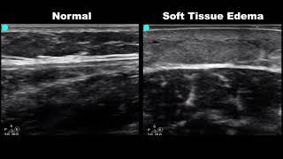 POCUS - Soft Tissue Ultrasound - Subcutaneous Air