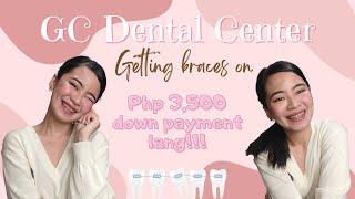 My Braces Journey... So far | GC Dental Center | Low Down Payment