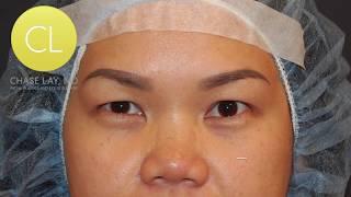 #ChaseLayMD Asian Eyelid Surgery: Deep Vietnamese Eyes