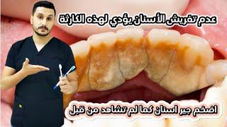 النهاية الابدية || اضخم جير اسنان كما لم تشاهد من قبل #dr_abdullah_sultan_dentist#dental_calculus