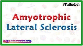 Amyotrophic Lateral Sclerosis: Etiology, Pathology, Clinical maifestations, Diagnosis and Treatment