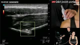 Diagnostic Shoulder Ultrasound: Part 4 - Superior Shoulder & Recap