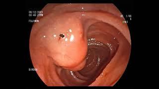 periampullary carcinoma ERCP and billiary stenting