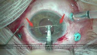 Needle guided technique for iris claw IOL implantation - Dr Sami A. Saad