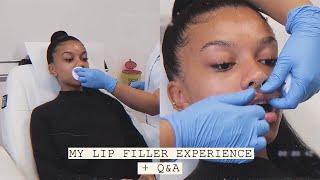 my lip filler experience + q&a.