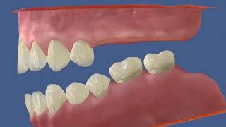 Деформация зубного ряда