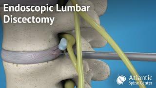 Endoscopic Lumbar Discectomy