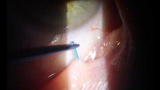 Punctal plug insertion