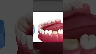 Gentle Dental Care: ASMR Cavity Removal and Crown Replacement