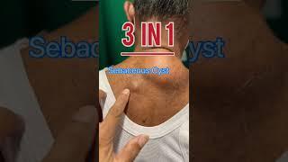 3 in 1  Lipoma/ Sebaceous cyst/ Pigmented mole