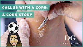 Callus with a core: a corn story