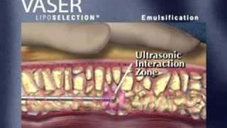 VASER Technique Overview