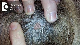 What does small skin colored lump on the scalp indicate? - Dr. Urmila Nischal