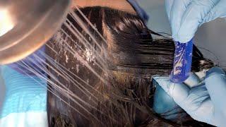 ASMR Lice Check & Removal, Scalp Treatment | Patient POV and 3rd Person POV