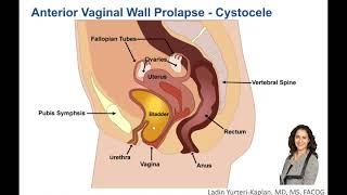 What is Anterior Vaginal Wall Prolapse?