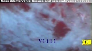 Abortion (MTP Video, MTP Procedure)