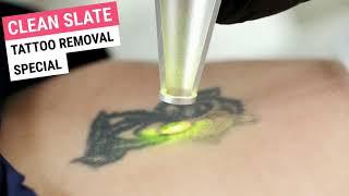 LASER TATTOO REMOVAL SPECIAL