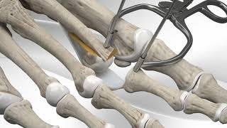 Toe Dislocation Repair with CPR™ Implant System