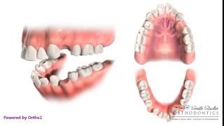 4 First Premolar Extraction for Retraction - Orthodontic Treatment