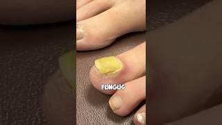 How to Remove Toenail Fungus 🩺🩻