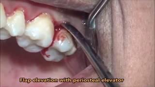 Extraction of tooth due to caries involving CEJ