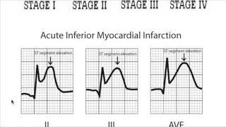Myocardial Infarction Vs Ac. Pericarditis & Dressler syndrome